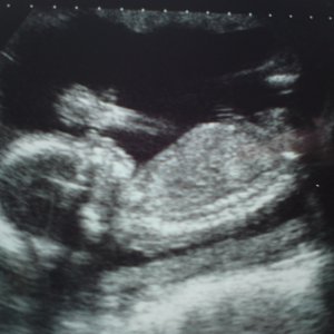 Baby @ 20 weeks